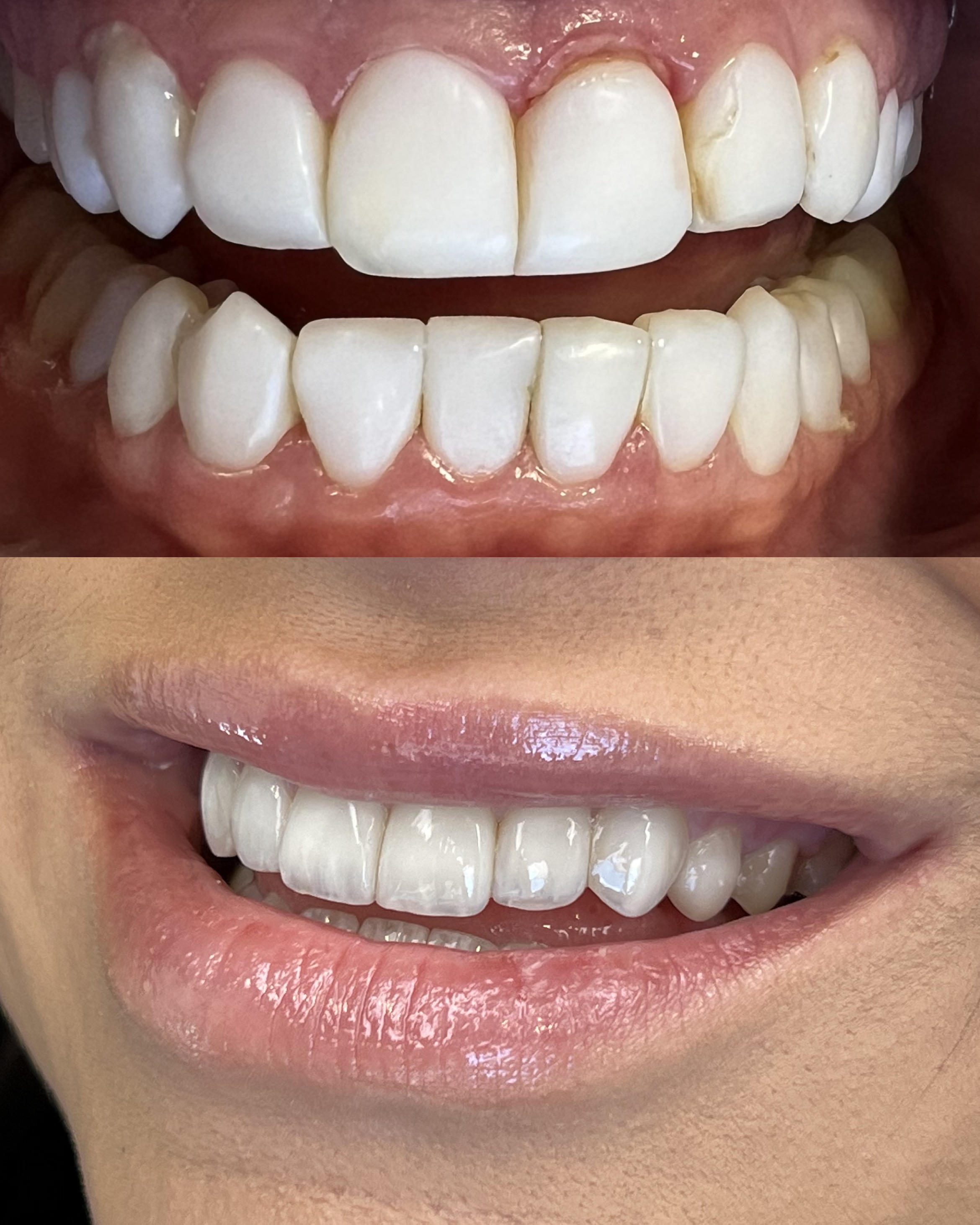 Antes e depois de um novo caso de facetas em resina