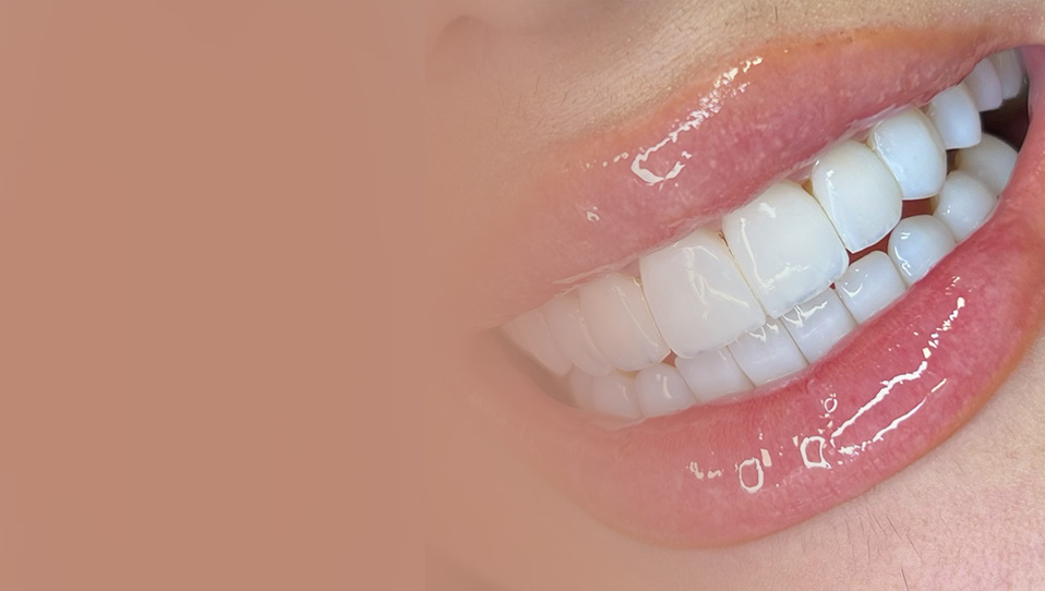 Clareamento dental em Curitiba - sorriso branco e iluminado