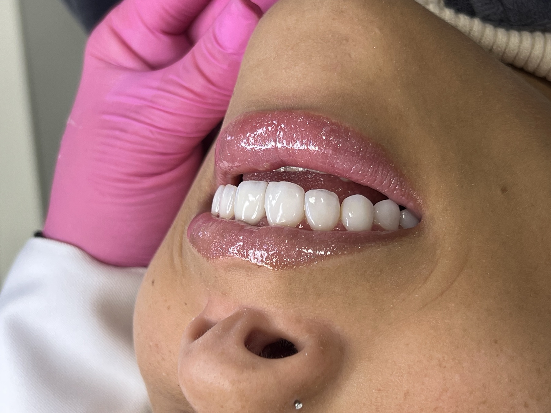 Clareamento dental em Curitiba com resultado natural