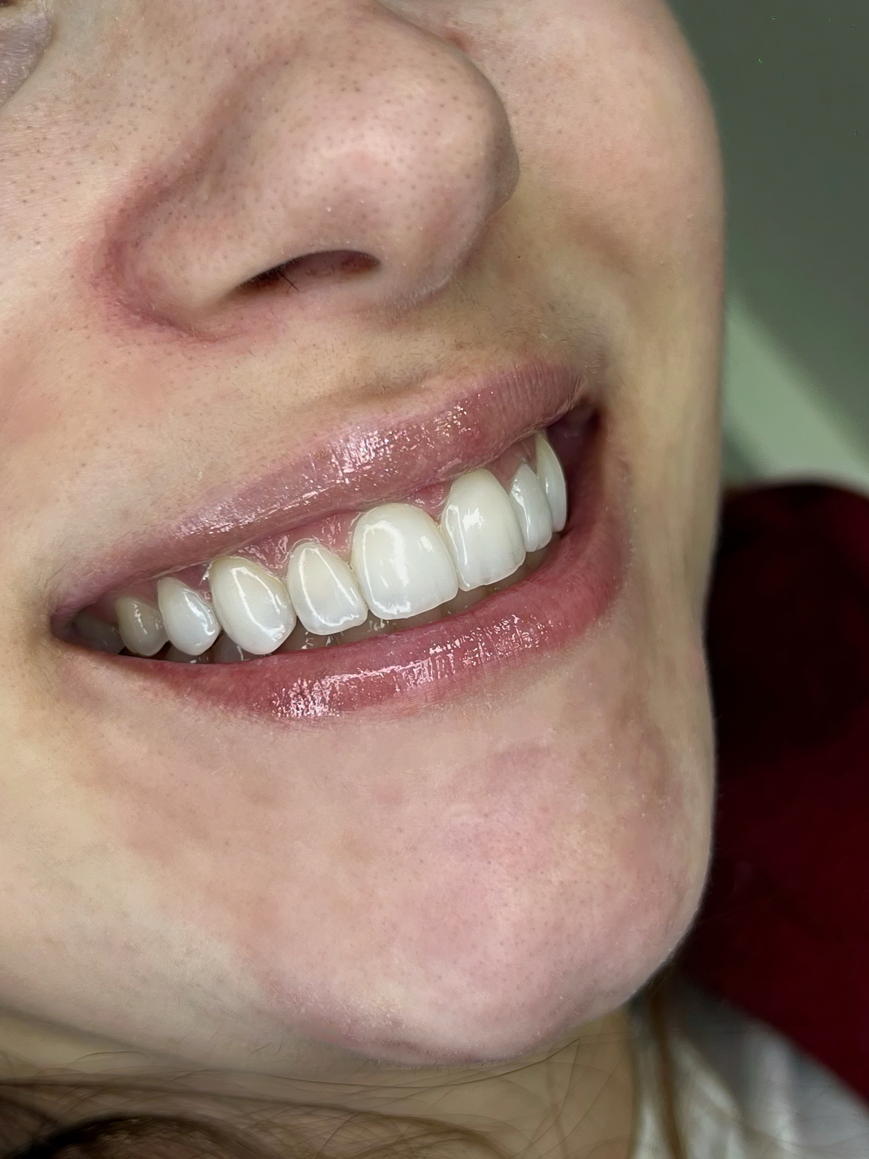 Resultado facetas em resina – Dra. Ana Repula
