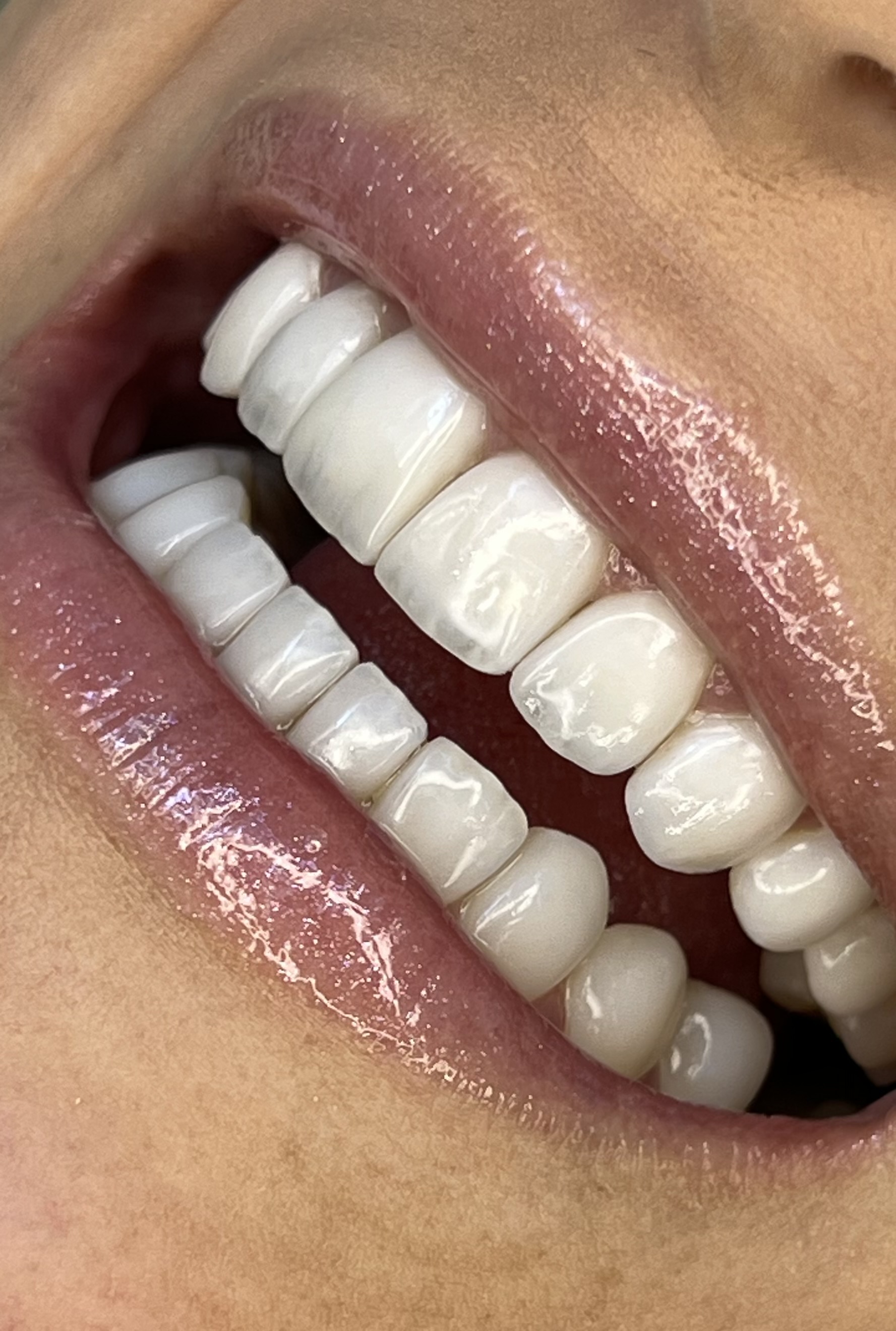 Sorriso natural com facetas em resina Curitiba