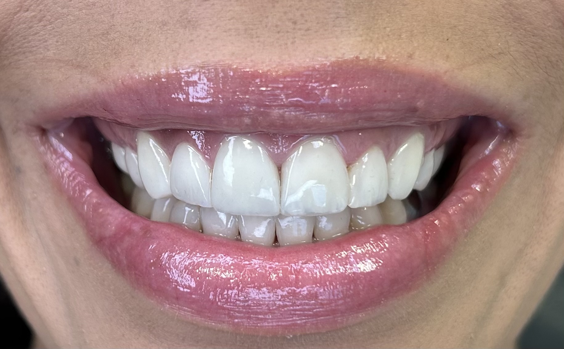 Harmonização orofacial Curitiba