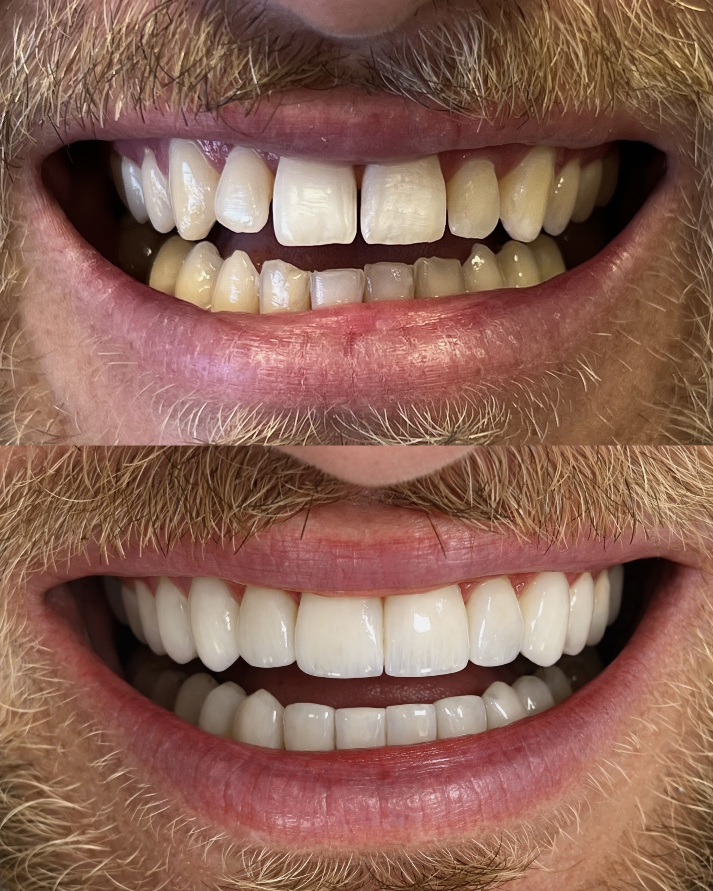 Facetas em resina antes e depois Curitiba