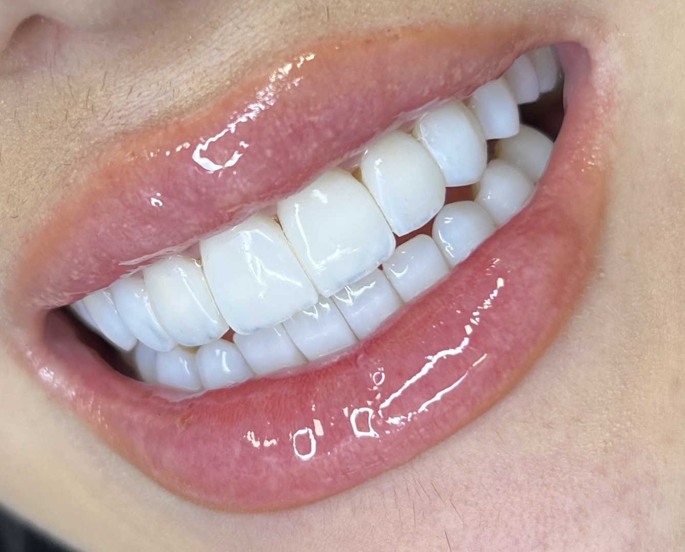 Sorriso saudável após limpeza dental em Curitiba