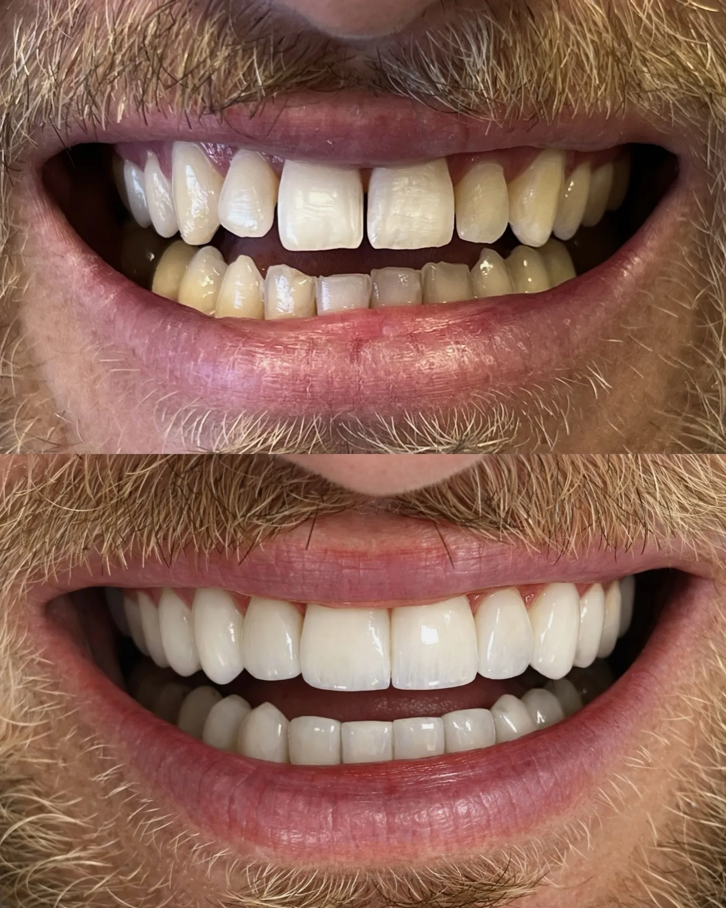 Transformação do sorriso com facetas em resina