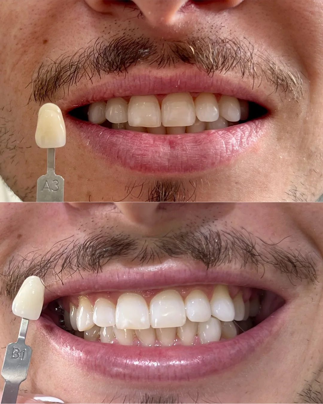 Sorriso após clareamento dental em Curitiba