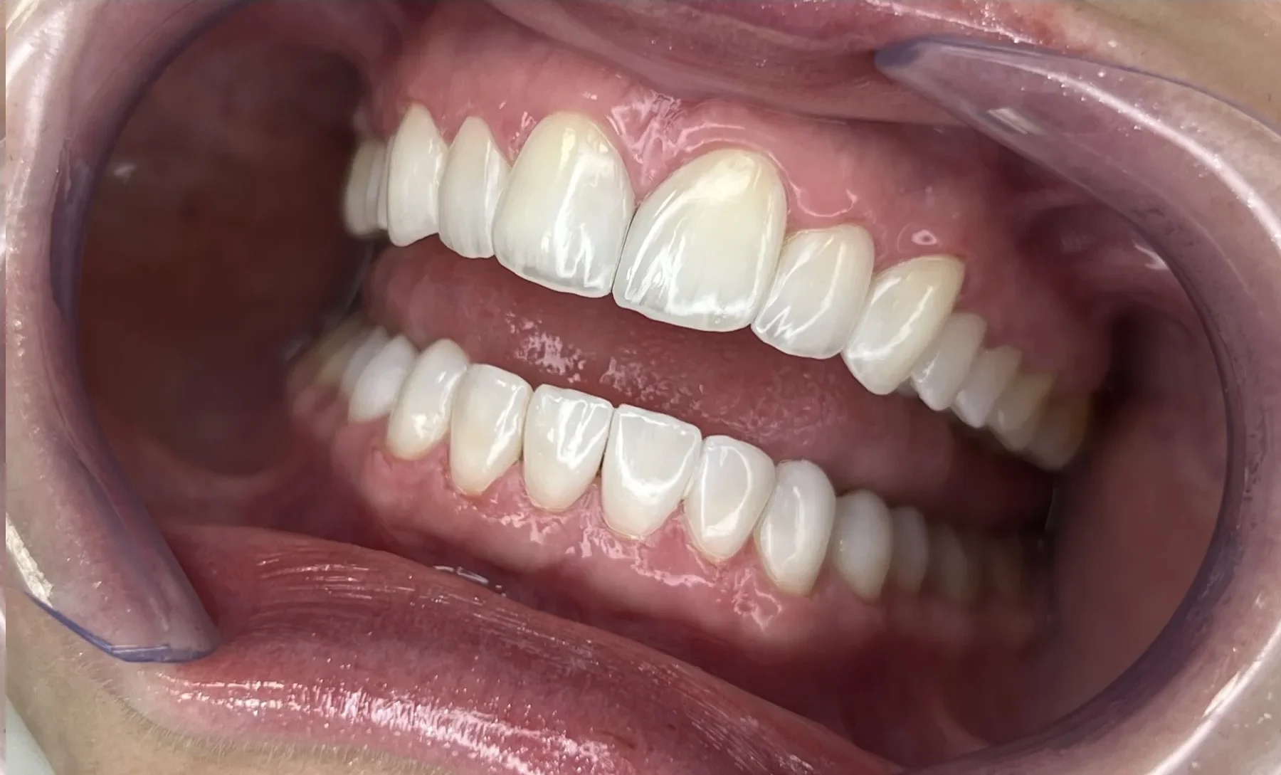 Sorriso com facetas em resina naturais em Curitiba