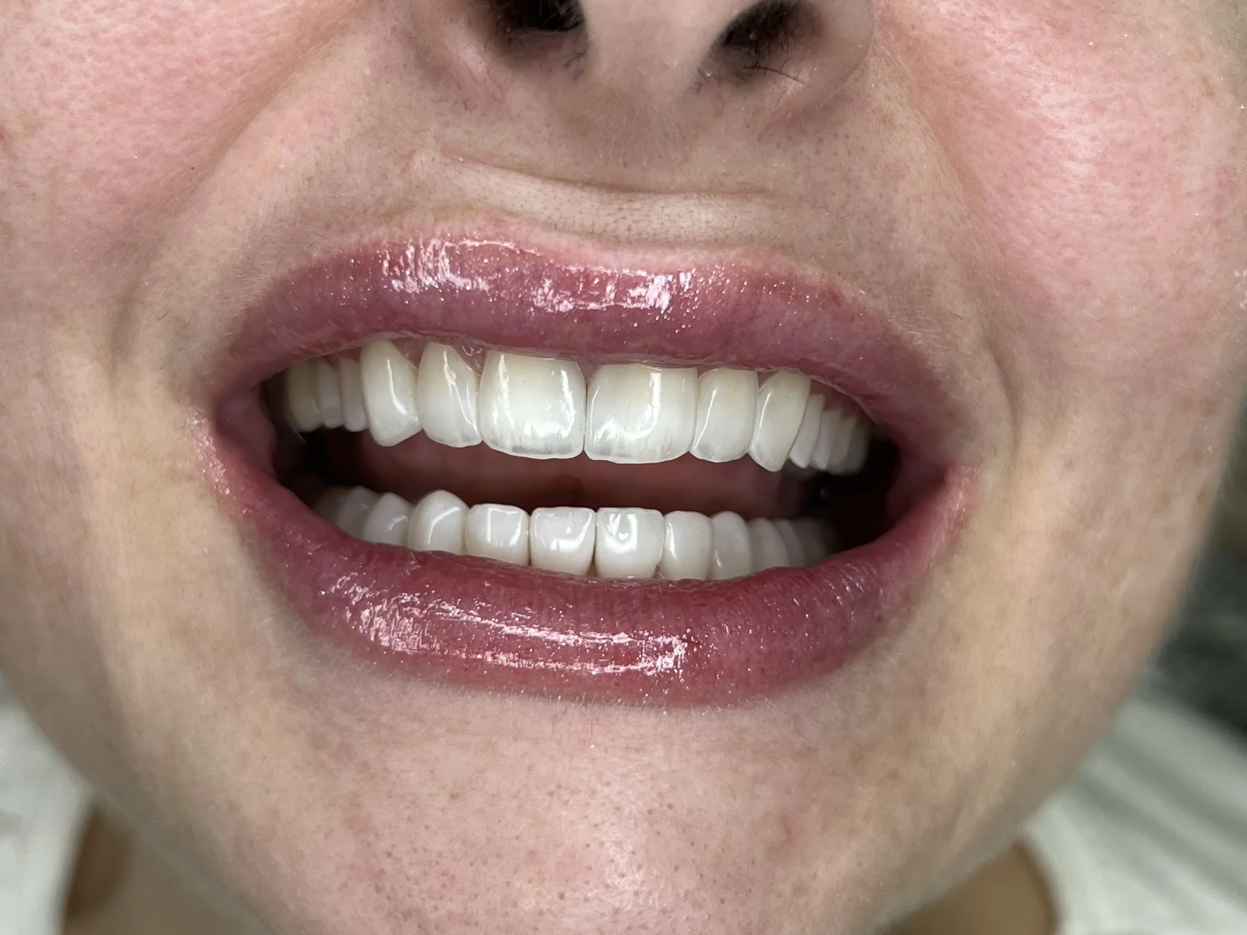Facetas em resina com sorriso harmônico e natural