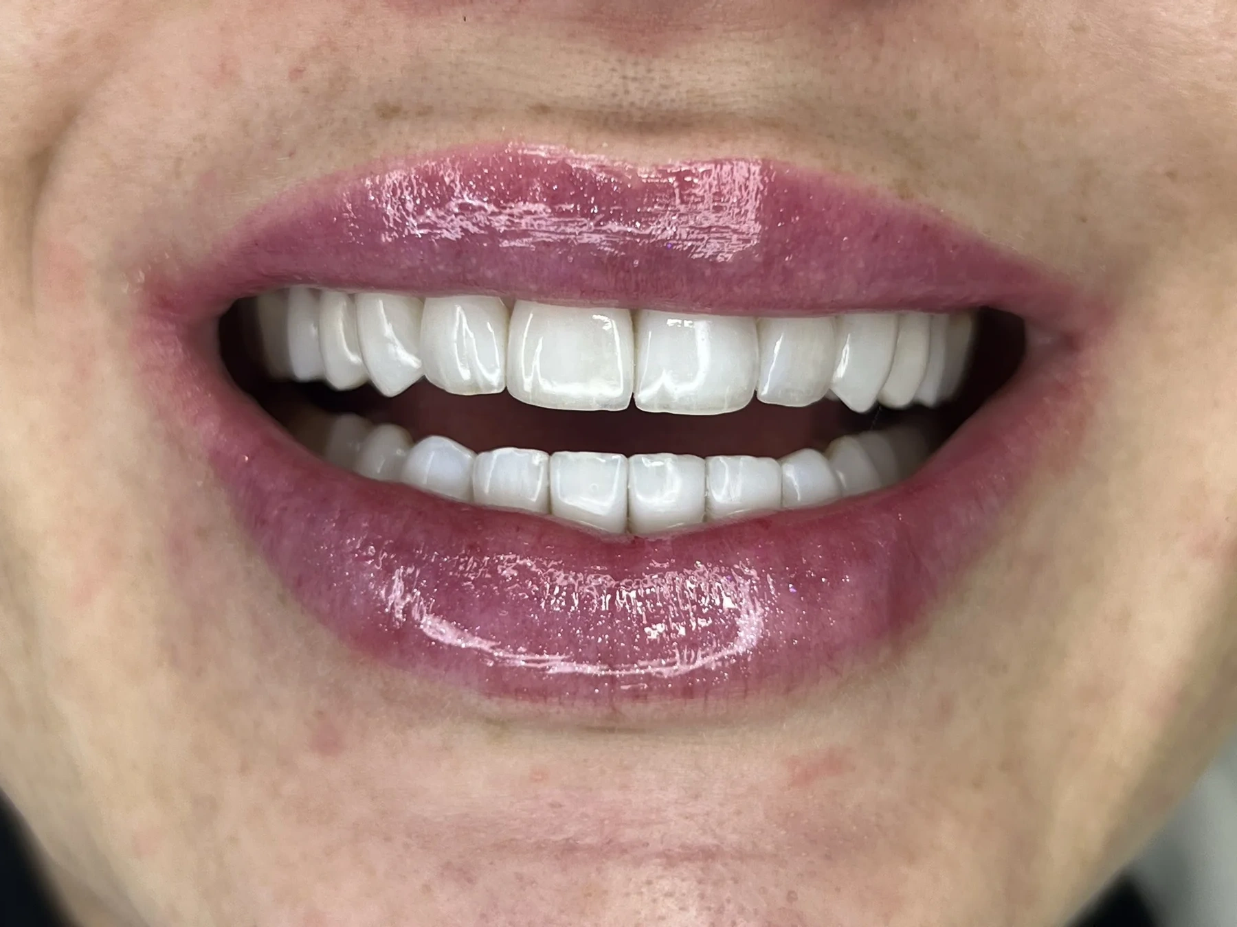 Detalhe de facetas em resina com acabamento natural