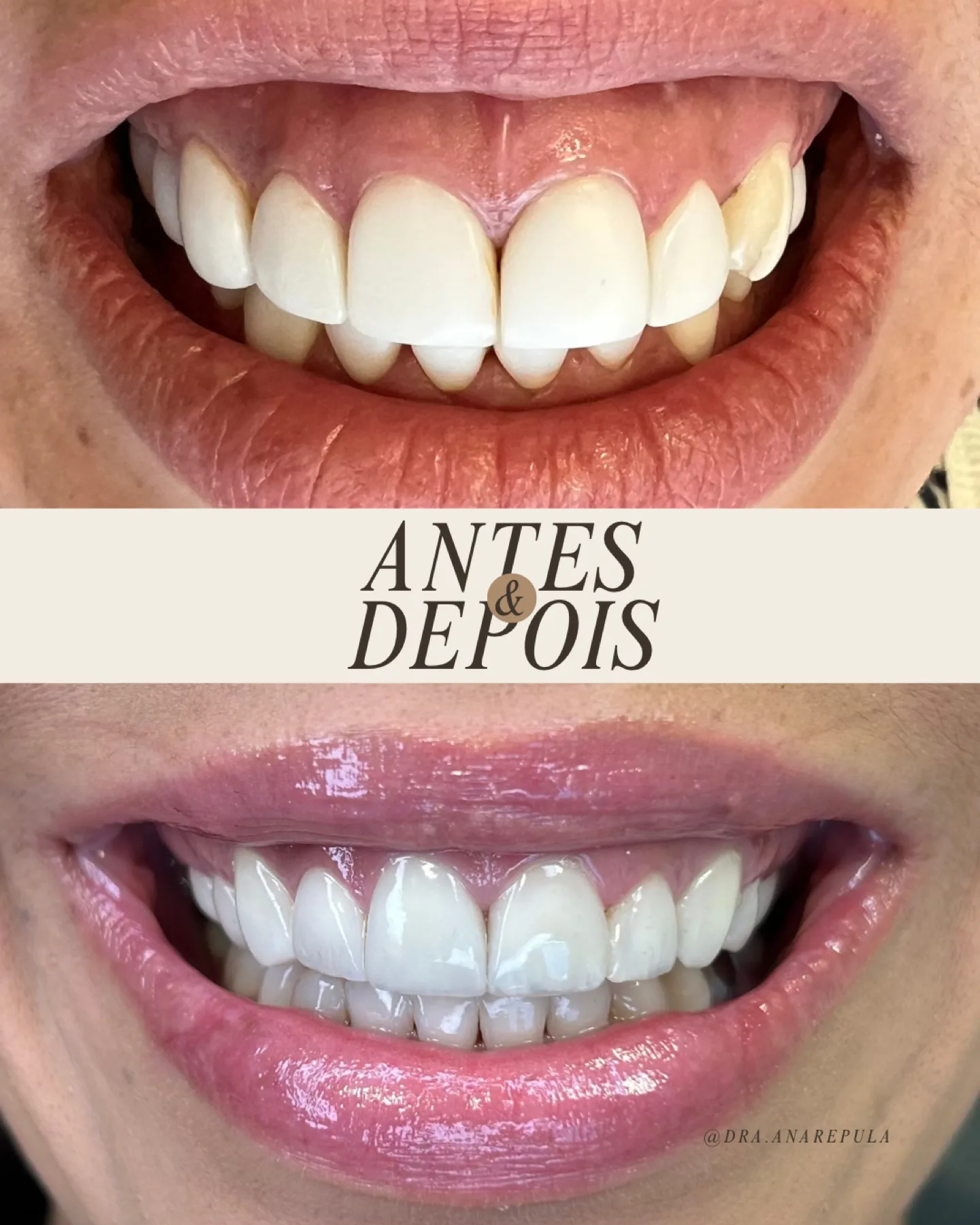 Retrabalho de facetas em resina em Curitiba
