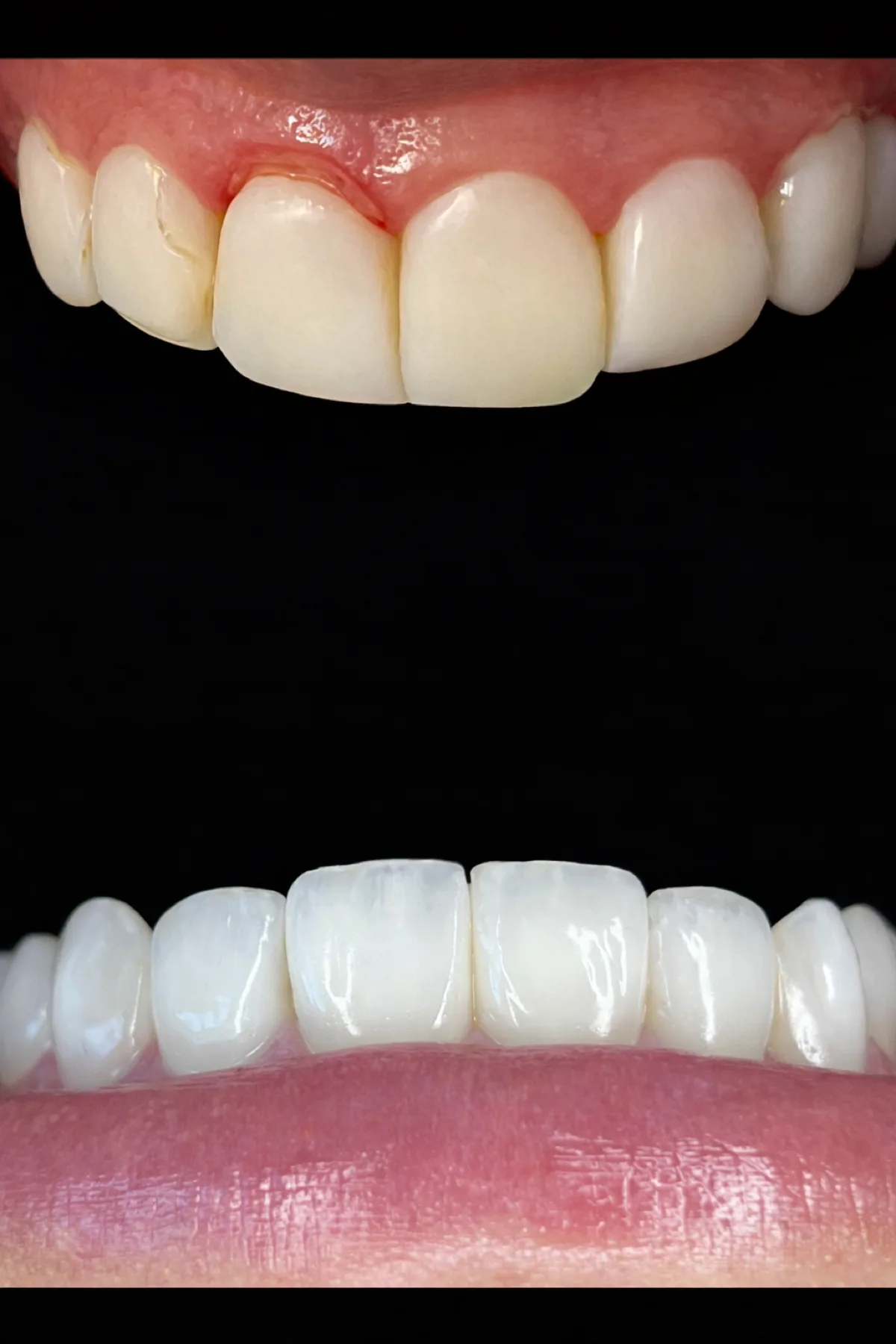 Troca de facetas em resina com resultado mais natural